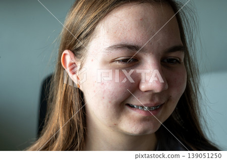Teenager girl with acne skin. High quality photo 139051250