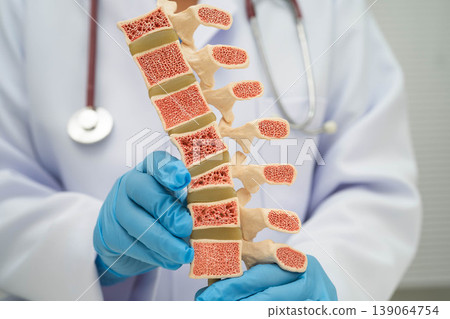 Doctor holding osteoporosis in back bone model for treatment medical in orthopedic department. Doctor holding osteoporosis in back bone model for treatment medical in orthopedic department. 139064754