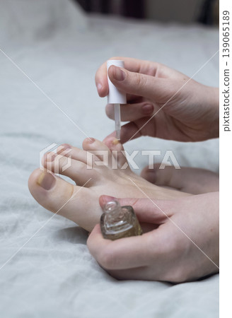 A woman in pajamas sitting on a bed and applying antifungal nail polish to treat onychomycosis. Home treatment of fungal infection, yellow nails, and medical pedicure for healthy feet. 139065189