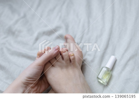 A woman in pajamas sitting on a bed and applying antifungal nail polish to treat onychomycosis. Home treatment of fungal infection, yellow nails, and medical pedicure for healthy feet. A woman in pajamas sitting on a bed and applying antifungal nail polish to treat onychomycosis. Home treatment of fungal infection, yellow nails, and medical pedicure for healthy feet. 139065195