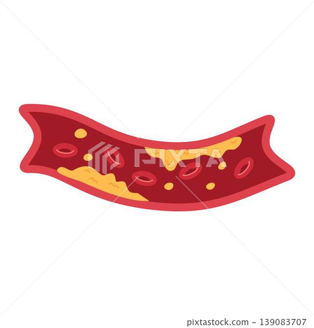 artery with cholesterol blocked in blood vessel illustration artery with cholesterol blocked in blood vessel illustration 139083707