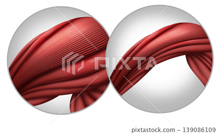 Muscle Atrophy Muscle Atrophy 139086109