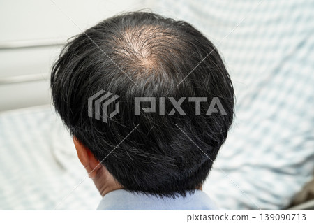 Bald in the middle head and begin no loss hair glabrous of mature Asian business smart active office man. Bald in the middle head and begin no loss hair glabrous of mature Asian business smart active office man. 139090713