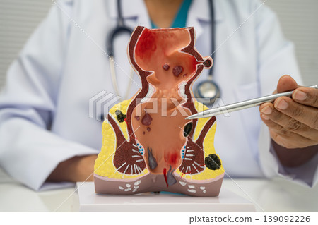 Asian doctor with rectum and hemorrhoid human model, inflamed vascular structure. Asian doctor with rectum and hemorrhoid human model, inflamed vascular structure. 139092226