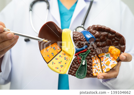 Cirrhosis, Liver cancer, fatty liver, Asian doctor with liver human model. 139104662