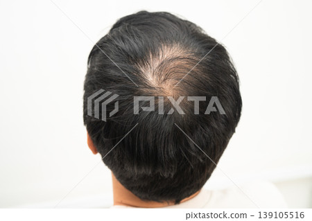 Bald in the middle head and begin no loss hair glabrous of mature man. 139105516