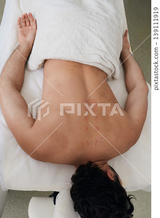 Acupuncture for a back of a adult man in a Chinese clinic. View from above 139111919