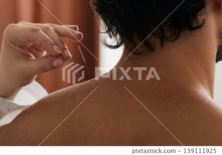 Reflexologist's hand with an acupuncture needle close-up while insert needle into a man's shoulder for treatment 139111925