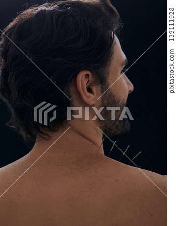 Acupuncture, reflexology. Close-up view from male patient back with acupuncture needles in his shoulder with pain, over black background Acupuncture, reflexology. Close-up view from male patient back with acupuncture needles in his shoulder with pain, over black background 139111928