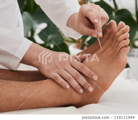 Acupuncture treatment for chronic foot pain. Chiropractor doing acupuncture therapy for patient feet with needles. Reflexology 139111944