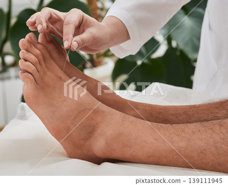Reflexologist doing acupuncture therapy for patient feet with needles. Acupuncture, reflexology, acupuncture treatment for chronic foot pain 139111945