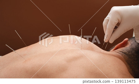 Close-up needle in the back of man during acupuncture procedure on a brown background. Acupuncture. Macro 139113475