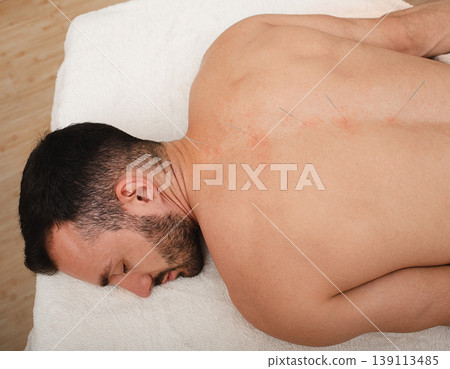 Male during spinal acupuncture procedure. Spinal acupuncture for intervertebral hernias and protrusions 139113485