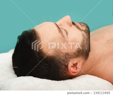 Man has a headache. Acupuncture treatment for migraines. Close-up acupuncture needles in a man's forehead on a blue background. 139113495