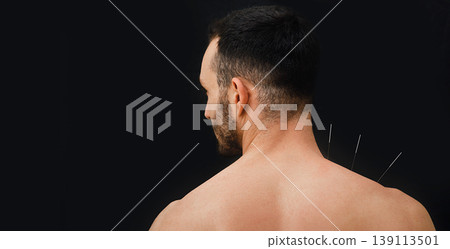 Close-up view from the back of a male patient with acupuncture needles in his shoulder on a black background. Acupuncture Close-up view from the back of a male patient with acupuncture needles in his shoulder on a black background. Acupuncture 139113501