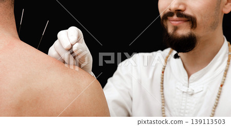 Needles for acupuncture in a man's shoulder close-up on a black background. A reflexologist very accurately doing acupuncture Needles for acupuncture in a man's shoulder close-up on a black background. A reflexologist very accurately doing acupuncture 139113503