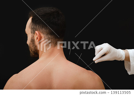 Reflexologist hand with acupuncture needle near the shoulder of a male Caucasian race. Treatment of a man body with Chinese medicine methods. Needles on a black background close-up Reflexologist hand with acupuncture needle near the shoulder of a male Caucasian race. Treatment of a man body with Chinese medicine methods. Needles on a black background close-up 139113505