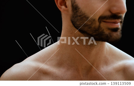 Close-up portrait of a male patient with acupuncture needles in his shoulder on a black background. Alternative medicine 139113509