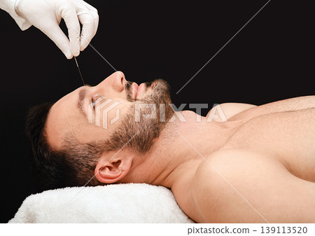 Acupuncture treatment to relieve stress and relax the body man. Acupuncture is a traditional Chinese medicine. Acupuncture needles close-up on a black background Acupuncture treatment to relieve stress and relax the body man. Acupuncture is a traditional Chinese medicine. Acupuncture needles close-up on a black background 139113520