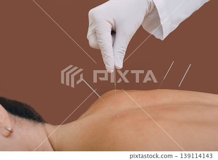 Acupunturist hand with acupuncture needle. Acupuncture treatment of chronic back pain of a woman Acupunturist hand with acupuncture needle. Acupuncture treatment of chronic back pain of a woman 139114143