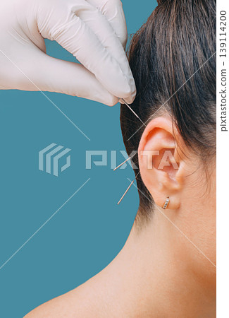 Hand of a reflexologist with an acupuncture needle near a woman's ear. Treatment of many diseases by ear acupuncture. Needles close-up on a blue background 139114200
