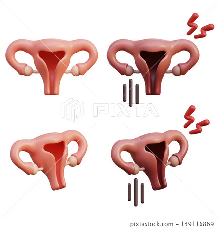 Healthy and Sick Uterus 3D Medical Icon Set Healthy and Sick Uterus 3D Medical Icon Set 139116869