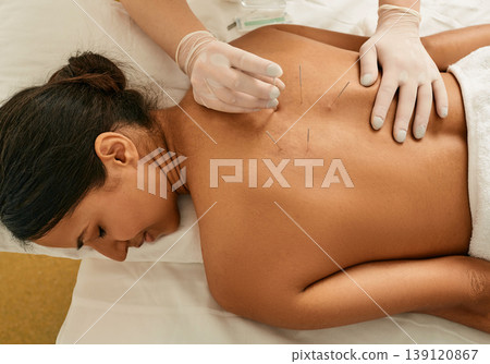 Acupuncture for a back of a young woman in a Chinese clinic. View from above 139120867
