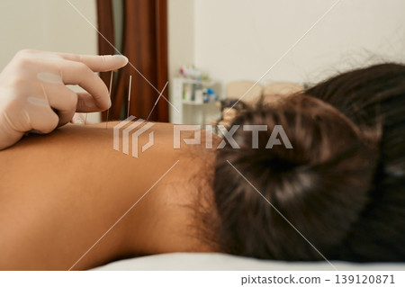 Reflexology. Treatment of back pain and tightness with acupuncture needles for a female patient Reflexology. Treatment of back pain and tightness with acupuncture needles for a female patient 139120871