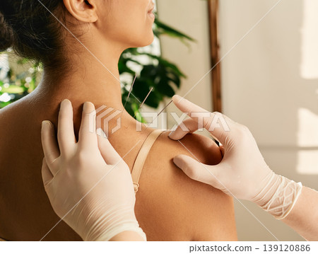 Reflexologist hand with acupuncture needle close-up during insert needle into a woman's shoulder for treatment. Acupuncture, reflexology Reflexologist hand with acupuncture needle close-up during insert needle into a woman's shoulder for treatment. Acupuncture, reflexology 139120886