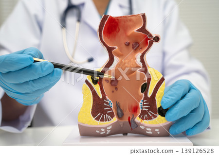 Asian doctor with rectum and hemorrhoid human anatomy model at hospital, inflamed vascular structure. Asian doctor with rectum and hemorrhoid human anatomy model at hospital, inflamed vascular structure. 139126528