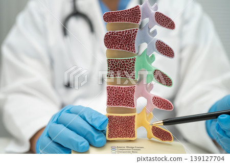 Doctor holding osteoporosis in back bone model for treatment medical. Doctor holding osteoporosis in back bone model for treatment medical. 139127704
