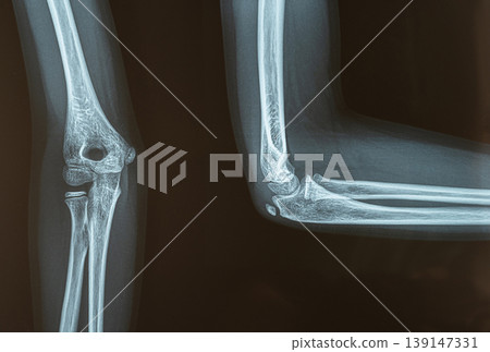 X-ray showing elbow joint with knee visible in medical setting X-ray showing elbow joint with knee visible in medical setting 139147331