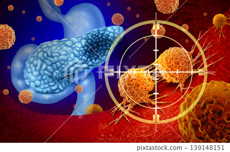 Pancreatic Cancer Treatment Pancreatic Cancer Treatment 139148151
