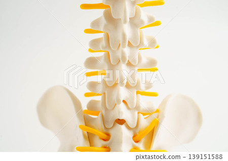 Spinal nerve and bone, Lumbar spine displaced herniated disc fragment, Model for treatment medical in the orthopedic department. Spinal nerve and bone, Lumbar spine displaced herniated disc fragment, Model for treatment medical in the orthopedic department. 139151588