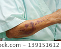 Ecchymosis, elderly bleeding on her arm after taking aspirin. 139151612