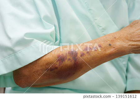 Ecchymosis, elderly bleeding on her arm after taking aspirin. 139151612
