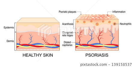 Psoriasis. Autoimmune skin condition. Psoriasis. Autoimmune skin condition. 139158537