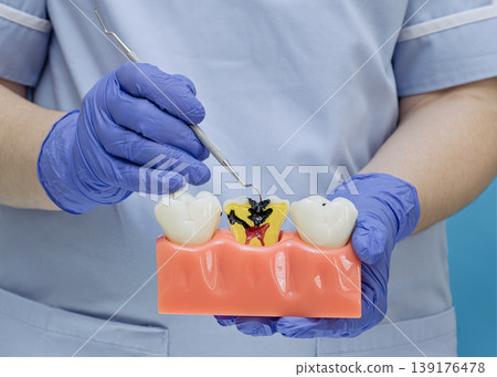 Dentist showing a cross-section dental model with tooth decay and inflammation using an explorer tool 139176478