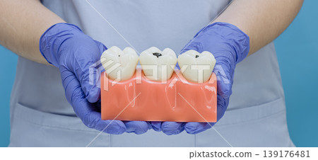 Dental care concept: Doctor holding a tooth model showing decay and cavities. Dental care concept: Doctor holding a tooth model showing decay and cavities. 139176481