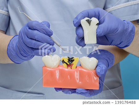 Endodontics concept: Dentist showing deep tooth decay and pulpitis on an anatomical cross-section model. Endodontics concept: Dentist showing deep tooth decay and pulpitis on an anatomical cross-section model. 139176488