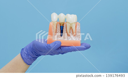 Dentist hand in blue glove holding anatomical cross-section model of teeth and titanium dental implant. Prosthodontics concept with copy space. Dentist hand in blue glove holding anatomical cross-section model of teeth and titanium dental implant. Prosthodontics concept with copy space. 139176493