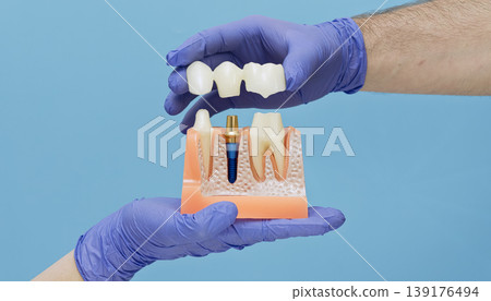 Dentist hands placing a dental bridge on an anatomical jaw model with a titanium implant. Prosthodontics and restoration concept. Dentist hands placing a dental bridge on an anatomical jaw model with a titanium implant. Prosthodontics and restoration concept. 139176494
