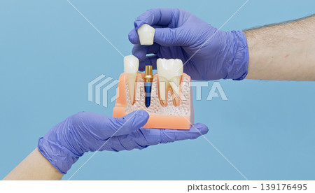 Dentist hands placing a single ceramic crown onto a titanium dental implant. Anatomical jaw model, prosthodontics concept. Dentist hands placing a single ceramic crown onto a titanium dental implant. Anatomical jaw model, prosthodontics concept. 139176495