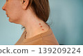 Woman with inflamed acne on her neck and jawline area. Problem skin treatment concept. Cosmetology concept. 139209224