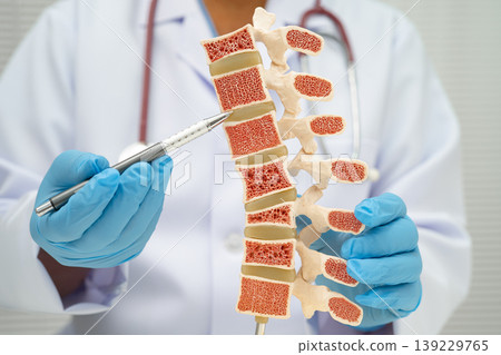 Doctor holding osteoporosis in back bone model for treatment medical in orthopedic department. 139229765