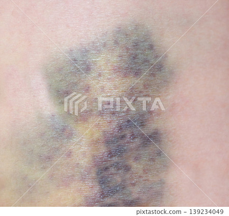 Close up purple bruise on skin. Bruise from impact. Bruising and hematoma on human body 139234049