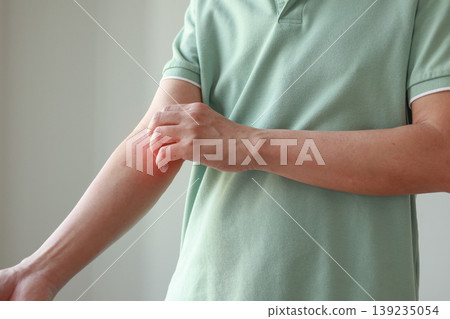Young asian man itching and scratching on arm from allergic itchy dry skin eczema dermatitis insect bites Young asian man itching and scratching on arm from allergic itchy dry skin eczema dermatitis insect bites 139235054