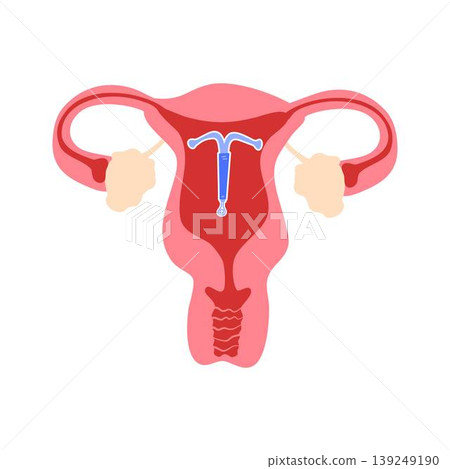 Illustration of Intrauterine Device in Uterus Illustration of Intrauterine Device in Uterus 139249190