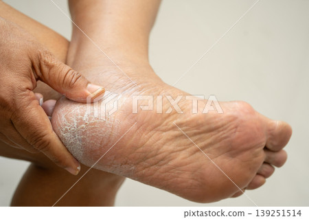 Asian woman care feet with cracked and dry heel skin cream at home. Asian woman care feet with cracked and dry heel skin cream at home. 139251514