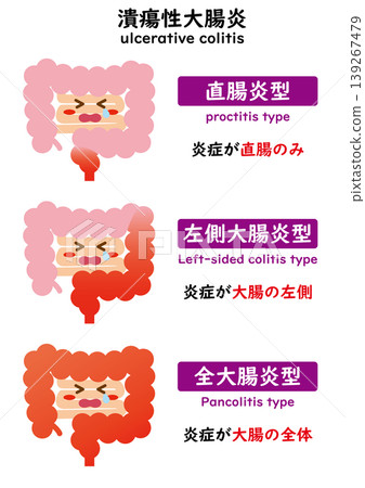 潰瘍性結腸炎的特徵 潰瘍性結腸炎的特徵 139267479